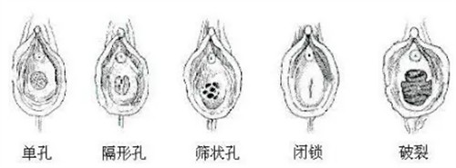 不同形状的处女膜