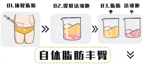 自体脂肪移植过程