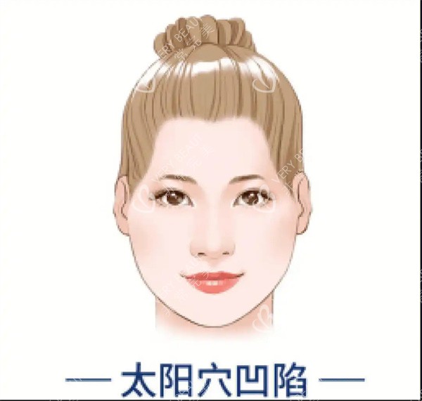 太阳穴凹陷