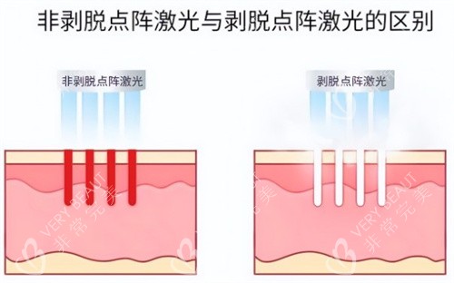 非剥脱点阵激光和剥脱点阵激光
