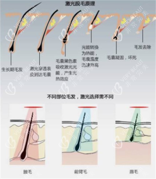 激光脱毛前后对比