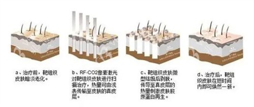 点阵激光治疗原理