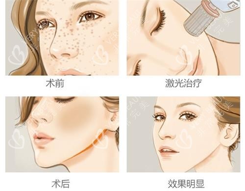 激光祛雀斑后的成效