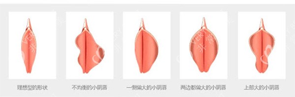 不同阴唇形状情况照片
