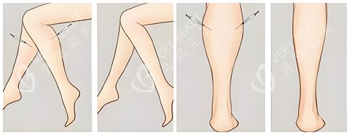 腿部吸脂手术前后对比动画图