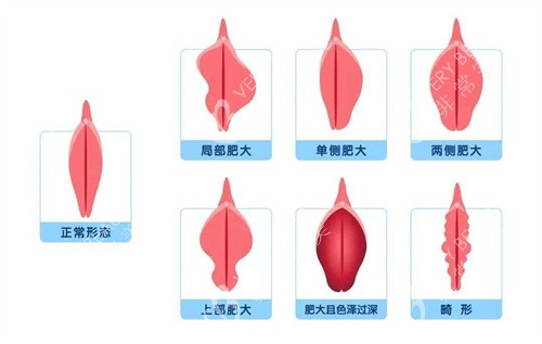 正常阴唇形态和阴唇肥大对比动画图