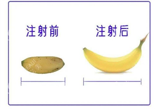 丁丁打玻尿酸前后对比
