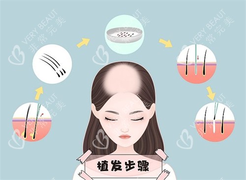 植发步骤