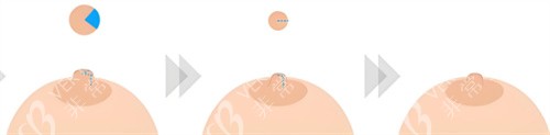 乳头缩小手术过程