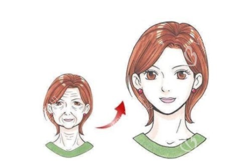 面部拉皮提升卡通对比图