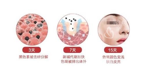 点阵激光