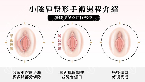 阴唇一边长一边短改善照片
