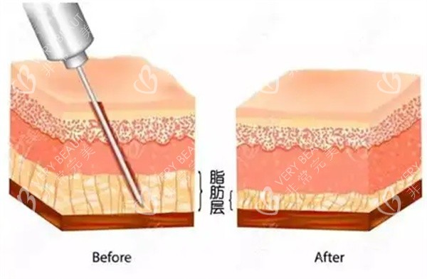 吸脂手术操作