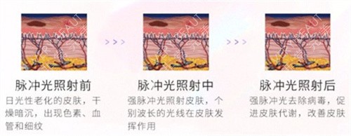 光子嫩肤对比