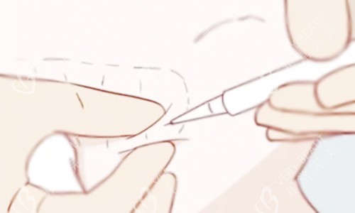 注射溶脂