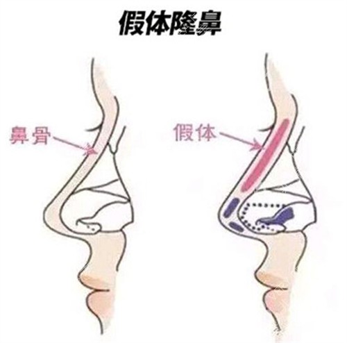 假体隆鼻对比
