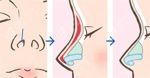 鼻部综合隆鼻术前术后展示图
