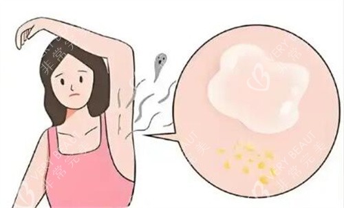 腋臭卡通图照片示意图