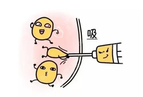 抽脂漫画示意图