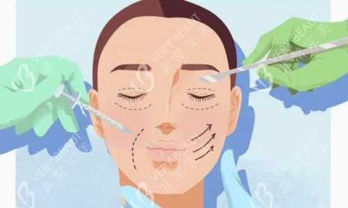 双眼皮手术操作示意图