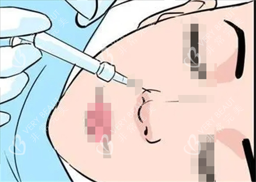 玻尿酸注射鼻子动画展示
