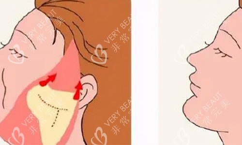 拉皮手术的术后对比图