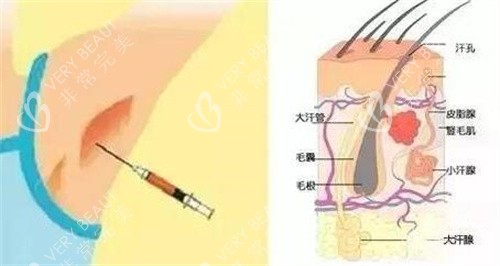 不手术去腋臭卡通图改善