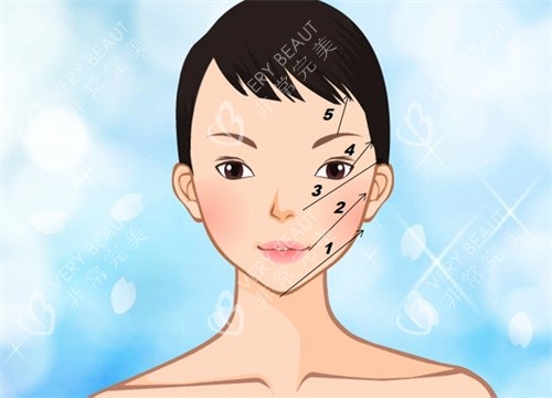 线提升