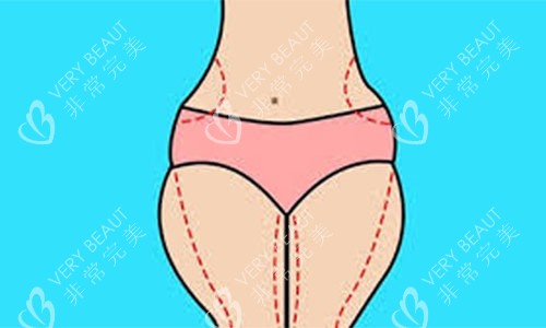 大腿吸脂手术设计方案示意图