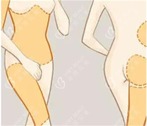 吸脂手术前后对比图