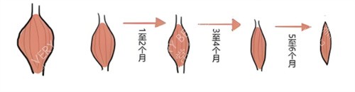 注射瘦腿肌肉缩小