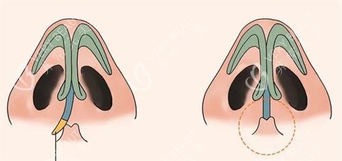 鼻中隔偏曲手术后的成效