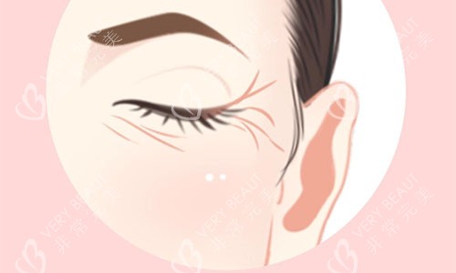 鱼尾纹