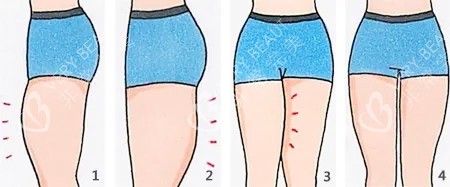 大腿吸脂卡通图