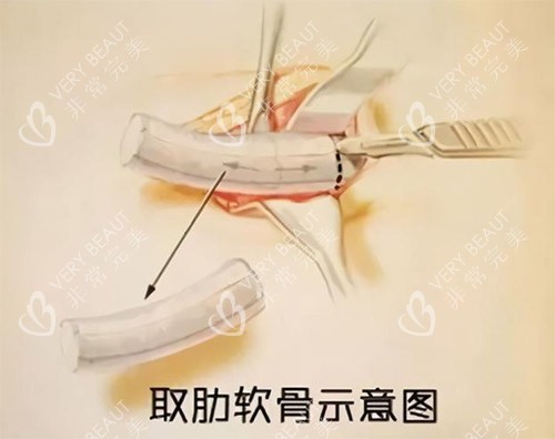 肋骨鼻手术过程图