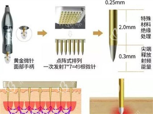 黄金微针手柄介绍