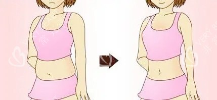 腰腹吸脂对比卡通图