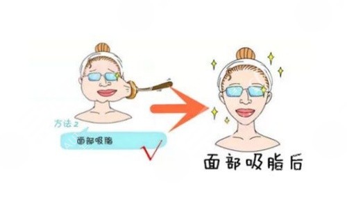 面部吸脂术后示意图