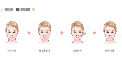 骸肌放松注射过程示意图