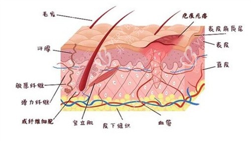疤痕增生原理