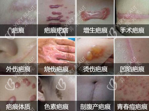 常见的疤痕类型展示图