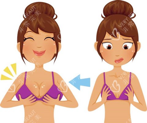 自体脂肪隆胸卡通图