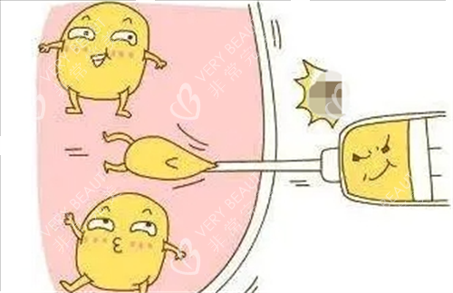 面部吸脂脂肪形象动画展示