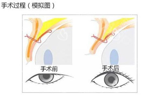 眼提肌手术照片