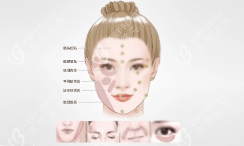 填充部位示意图