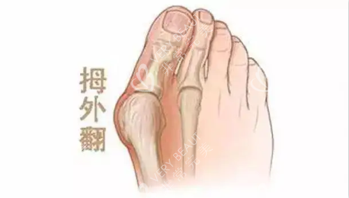 大脚骨示意图