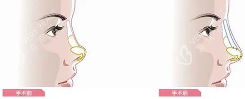隆鼻前后对比图