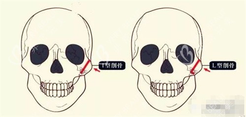颧骨整形图片