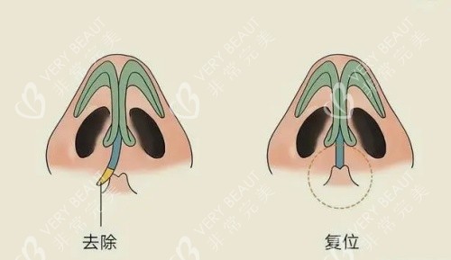 歪鼻修复矫正