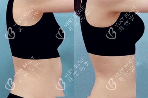 腰腹部吸脂手术前后对比图